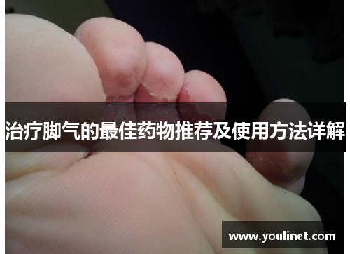 治疗脚气的最佳药物推荐及使用方法详解
